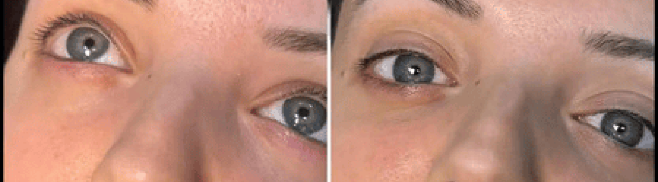Dermal Fillers